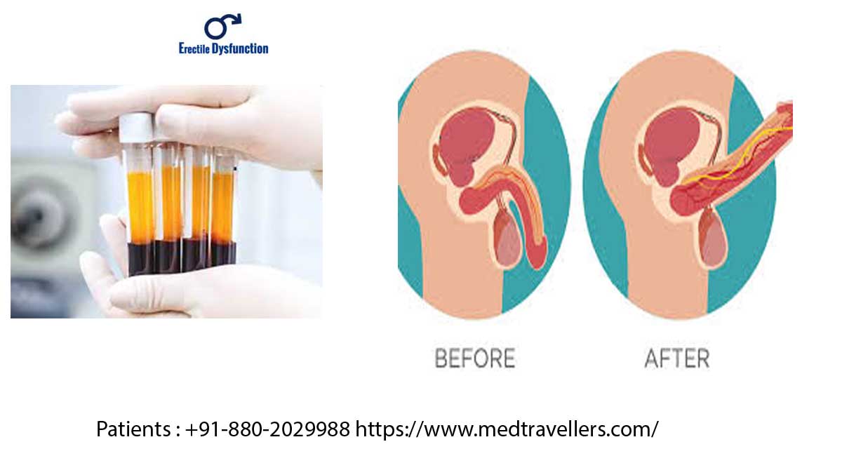 Platelet Rich Plasma (PRP) for Erectile Dysfunction